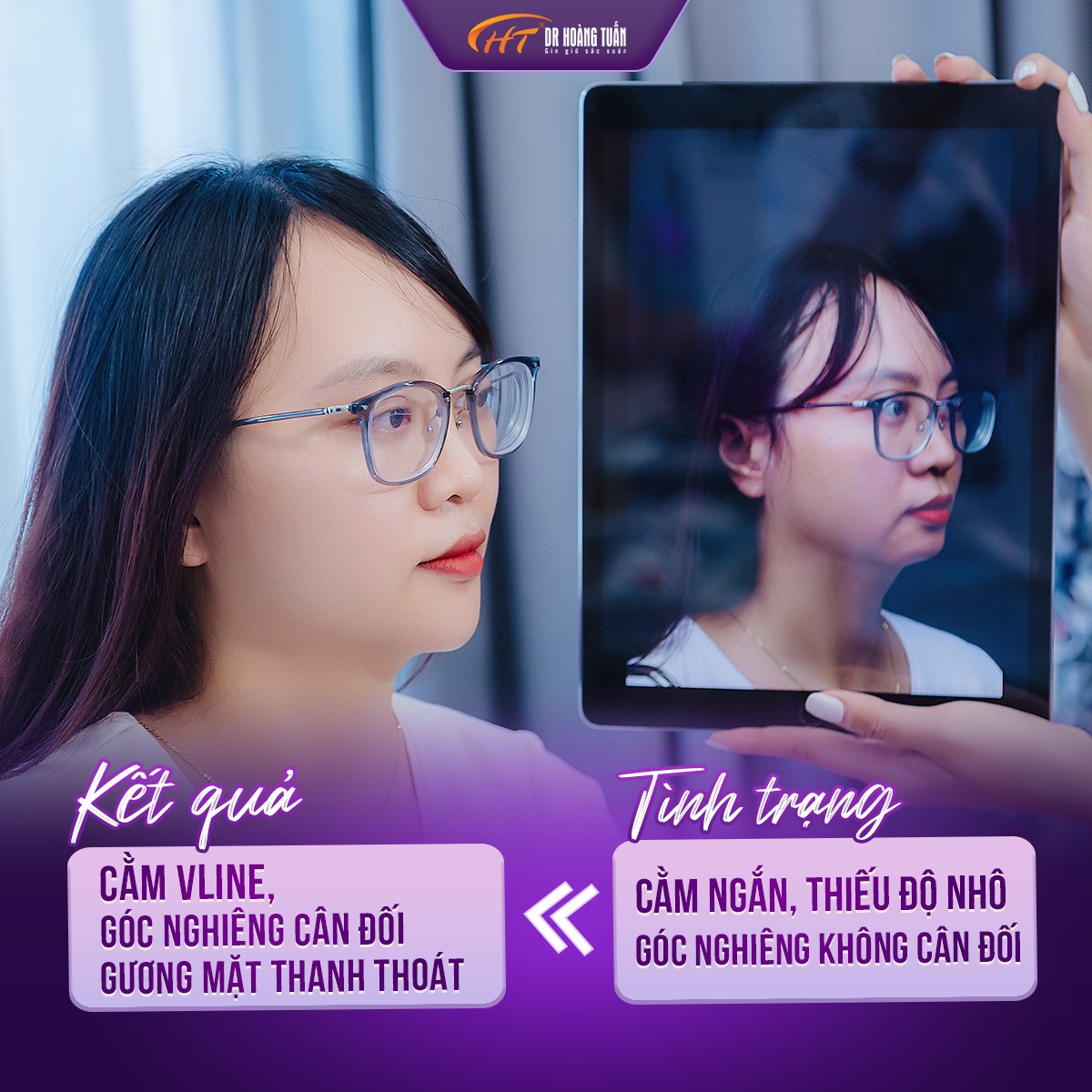 tiêm filler cằm